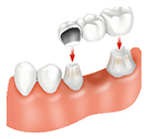 Dental Bridge